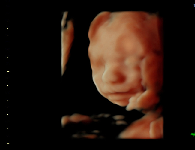 3D ultrasound image at 25 weeks